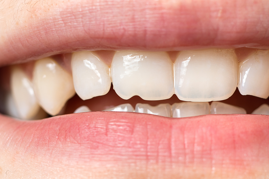 Chipped Tooth in Woodstock, GA: Causes, Treatments, and Prevention